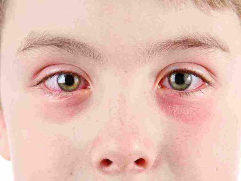 أمراض العيون عند الأطفال وعلاجها موقع زيادة
