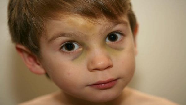 تزداد أسباب السواد تحت العينين عند الأطفال وطرق العلاج