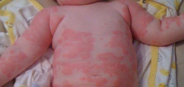 احمرار الجلد عند الأطفال وأنواعه موقع زيادة