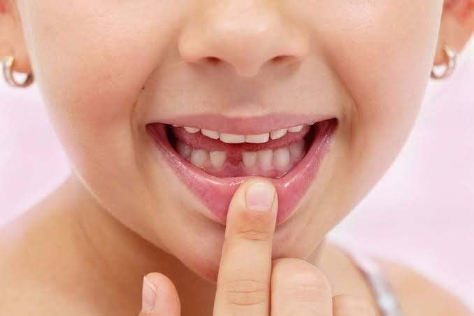 ترتيب سقوط الأسنان اللبنية في عمر خمس سنوات موقع زيادة