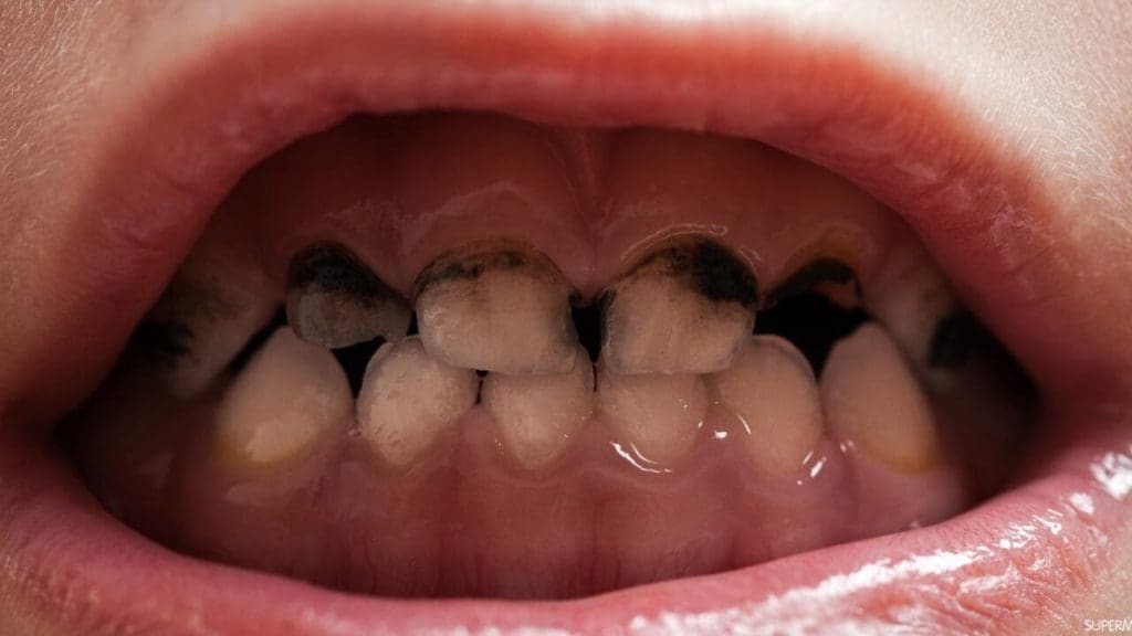 علاج تسوس الأسنان عند الأطفال وأسبابها موقع زيادة