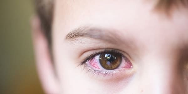 علاج احمرار العين عند الأطفال بالأعشاب موقع زيادة