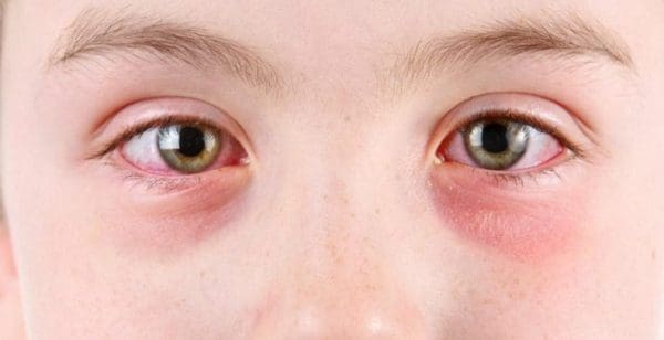 ما هي أسباب كثرة رمش العين عند الأطفال موقع زيادة
